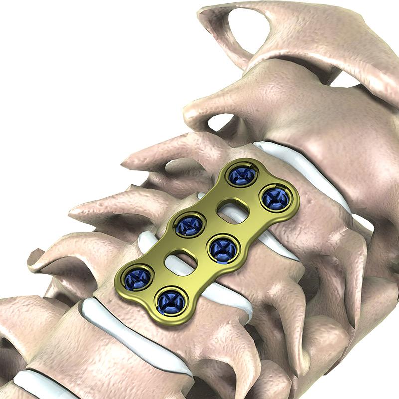 Пластина шийна